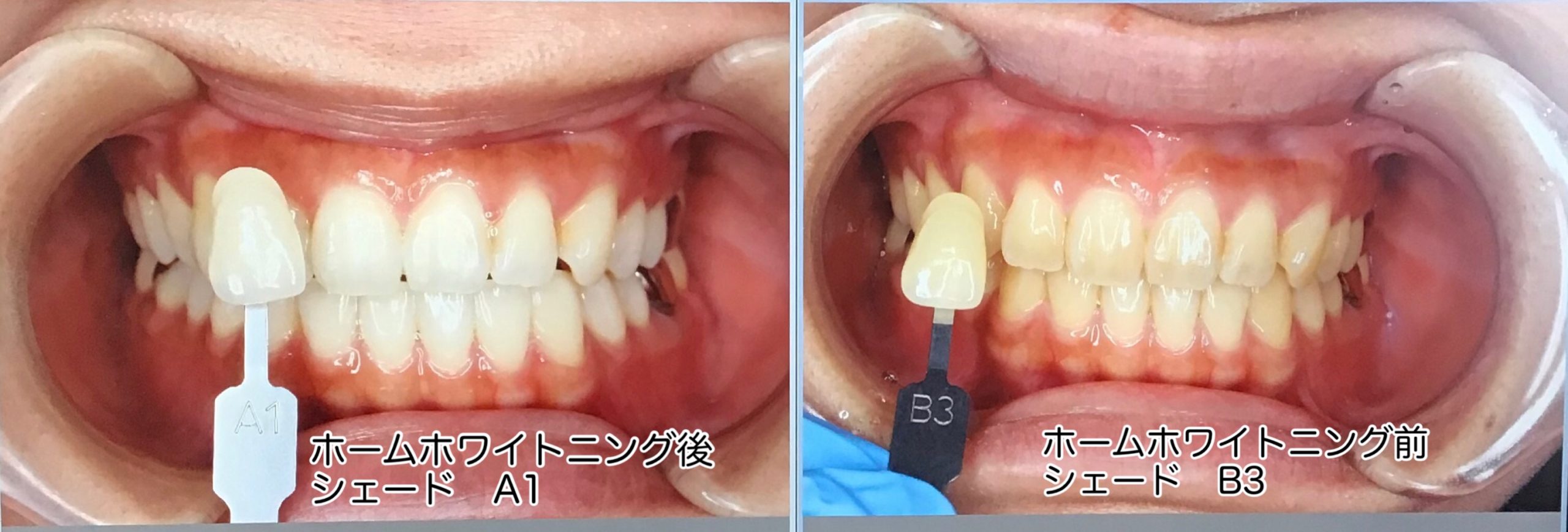 ホワイトニングの症例について 蓮ヶ池歯科口腔外科 周術期口腔ケア